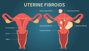 Uterine Fibroids