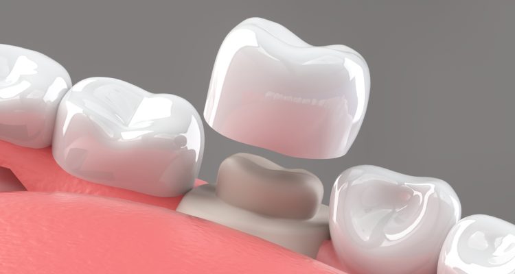 Dental-Crowns-Inner