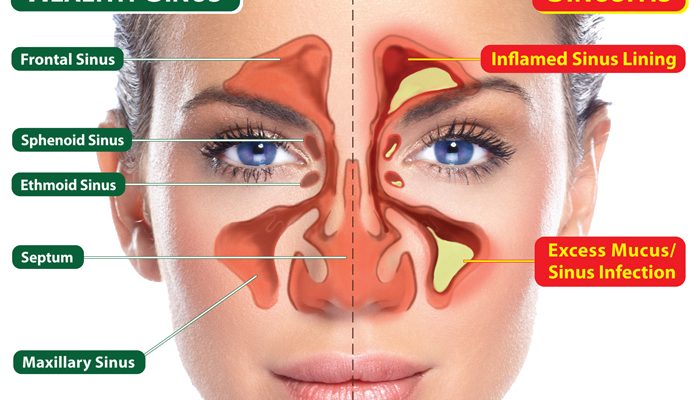 Sinusitis2