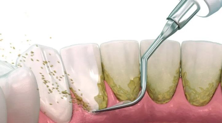 how root planing helps manage periodontitis