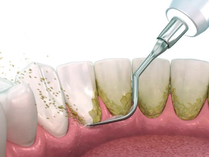 how root planing helps manage periodontitis