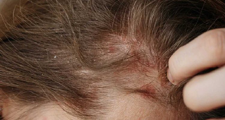 can eczema cause baldness