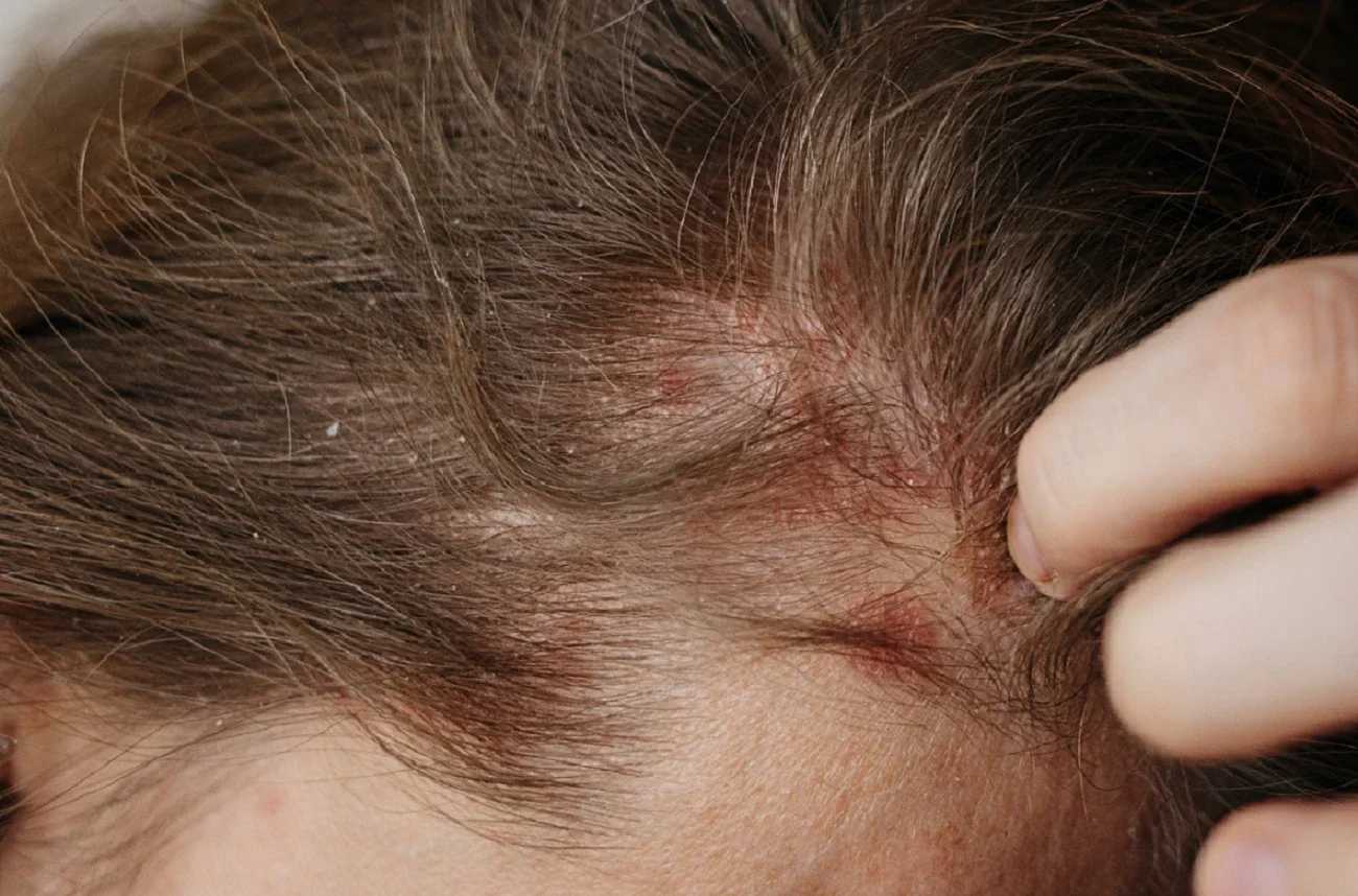 can eczema cause baldness