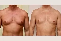 Gynecomastia-Surgery-in-Dubai-Abu-Dhabi