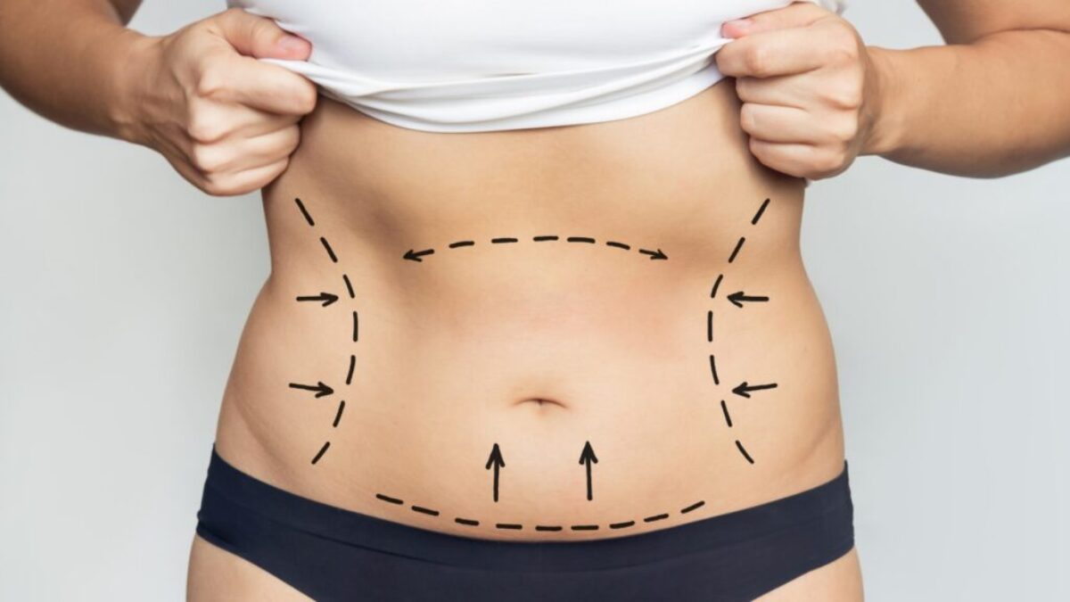 Liposuction Surgery Cost