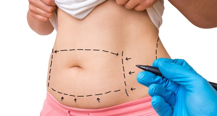 Tighten-Loose-Skin-with-a-Tummy-Tuck