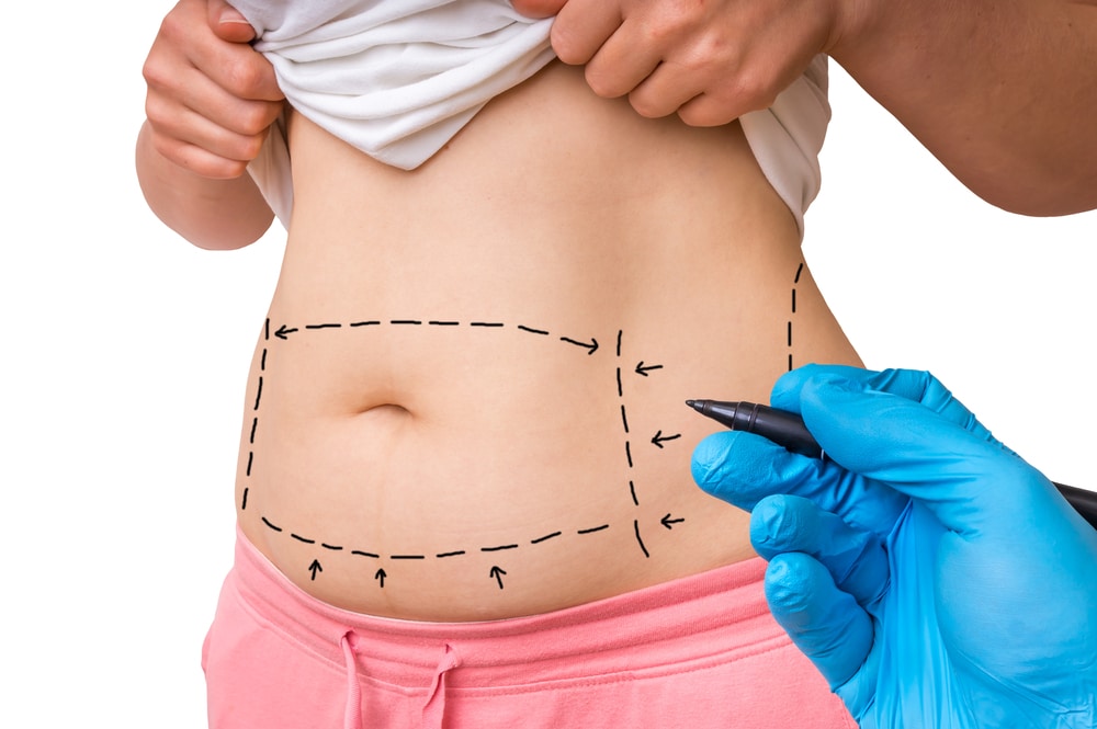 Tighten-Loose-Skin-with-a-Tummy-Tuck