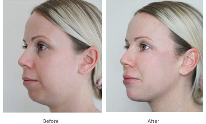 dermal-fillers-full-face-rejuvenation-before-after (1)