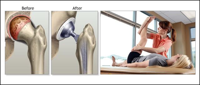 hip replacement recovery