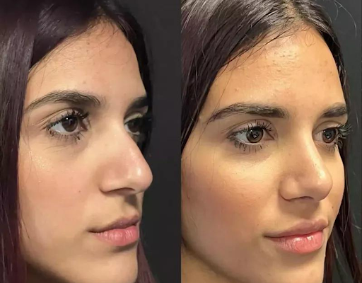 A Complete List of the Best Doctors in Dubai for Rhinoplasty Surgery